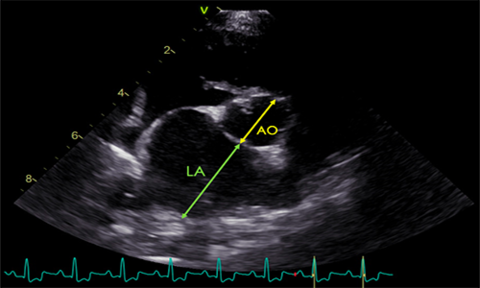 MMVD echocardiographic measurement